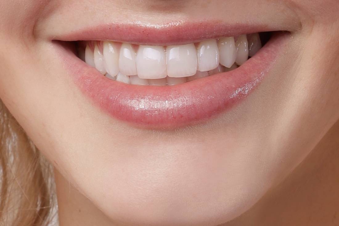 Invisalign smile